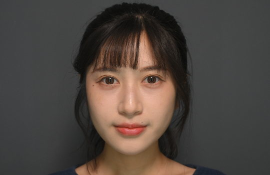 療程前｜AI美光針｜菲菲